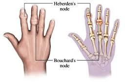 artroza malih zglobova nogu i ruku liječenje