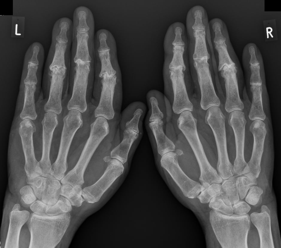 Osteoartritis ruku: liječenje, simptomi i uzroci - Bolesti I Stanja 