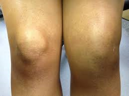 bol u koljenom zglobu oteklina ispod koljena