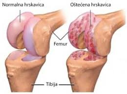 bol u koljenu i kriza liječenje boli u zglobu koljena