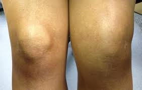 trzanje bolova u zglobu koljena